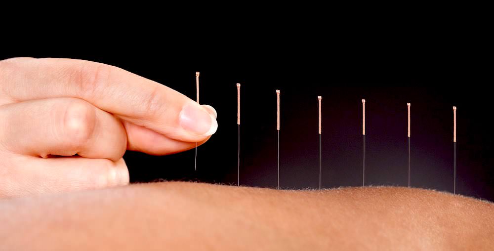 acupuntura y sus beneficios the concept 180